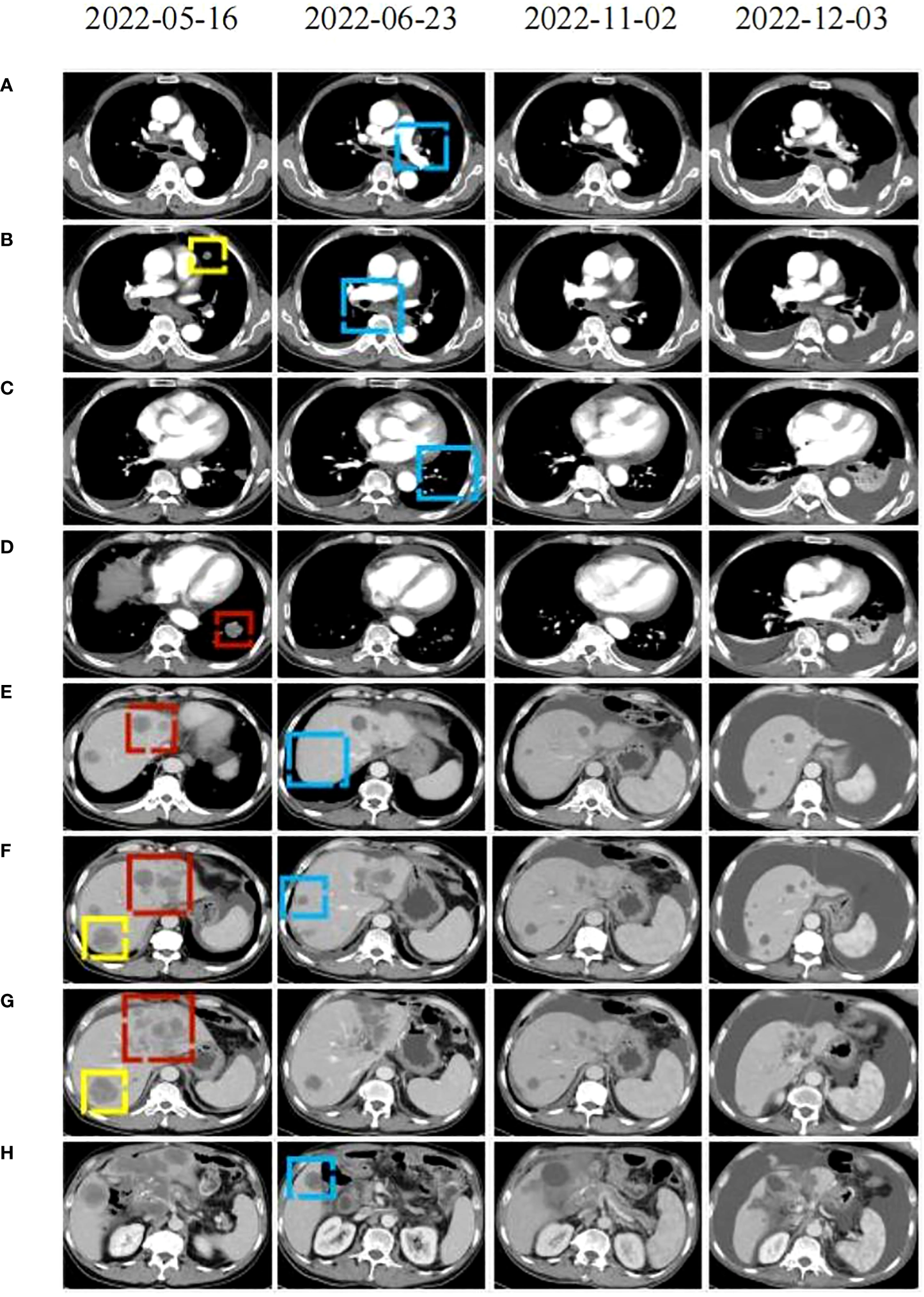 Four dated columns of CT scans showing lesions at baseline, during response and at later progression in one patient.